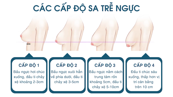 Cách nhận biết ngực chảy xệ
