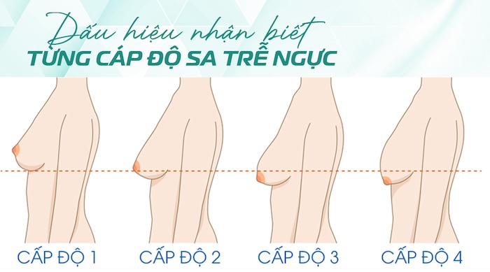 Cải thiện ngực chảy xệ