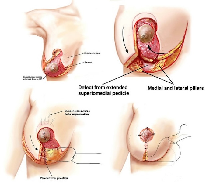 Căng da ngực chảy xệ