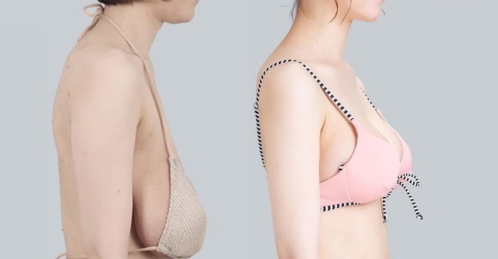 Có ai nâng ngực chảy xệ chưa