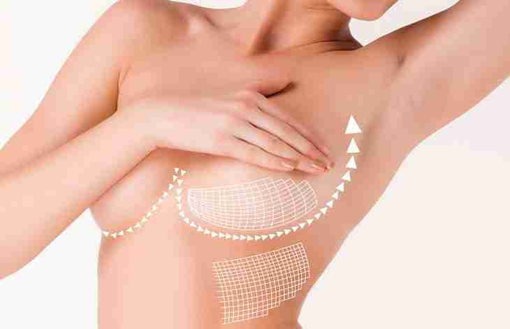 Giá nâng ngực chảy xệ
