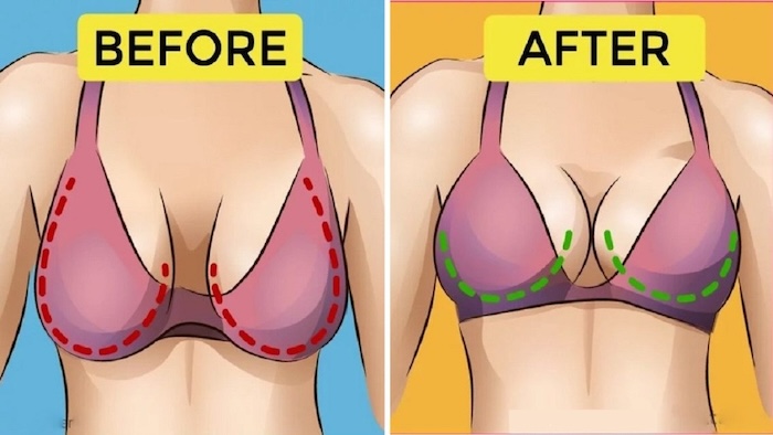 Hình ảnh nâng ngực chảy xệ