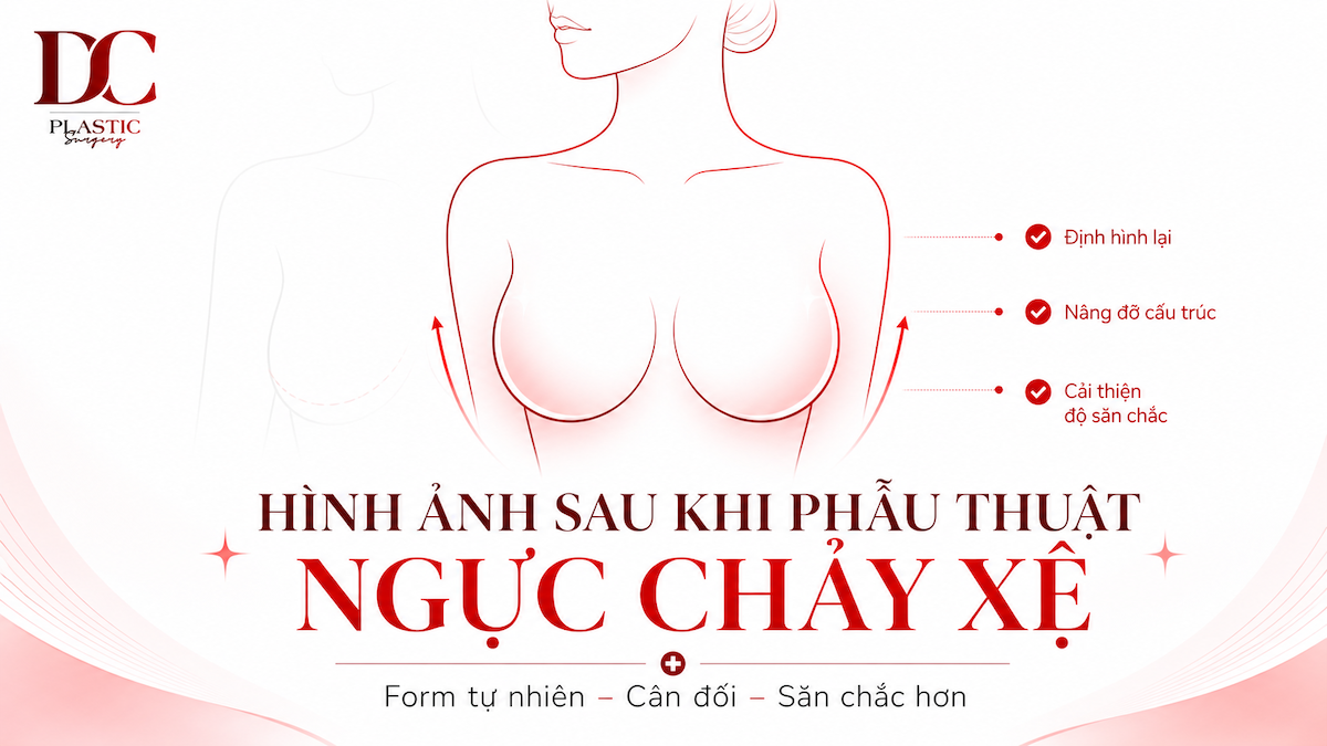 Hình ảnh sau khi phẫu thuật ngực chảy xệ