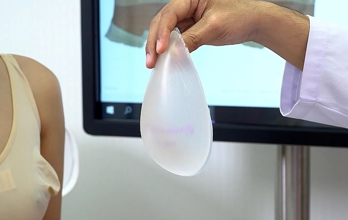 Nâng ngực nội soi 3d túi giọt nước