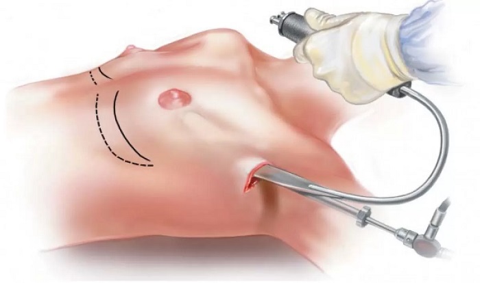 Nâng ngực nội soi có đau không