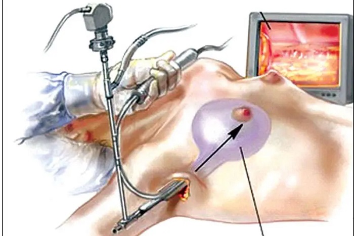Nâng ngực nội soi là gì