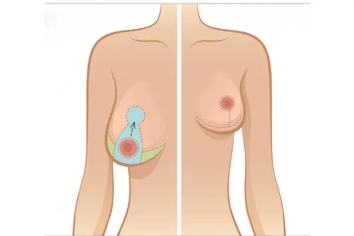 Ngực chảy xệ phải làm thế nào