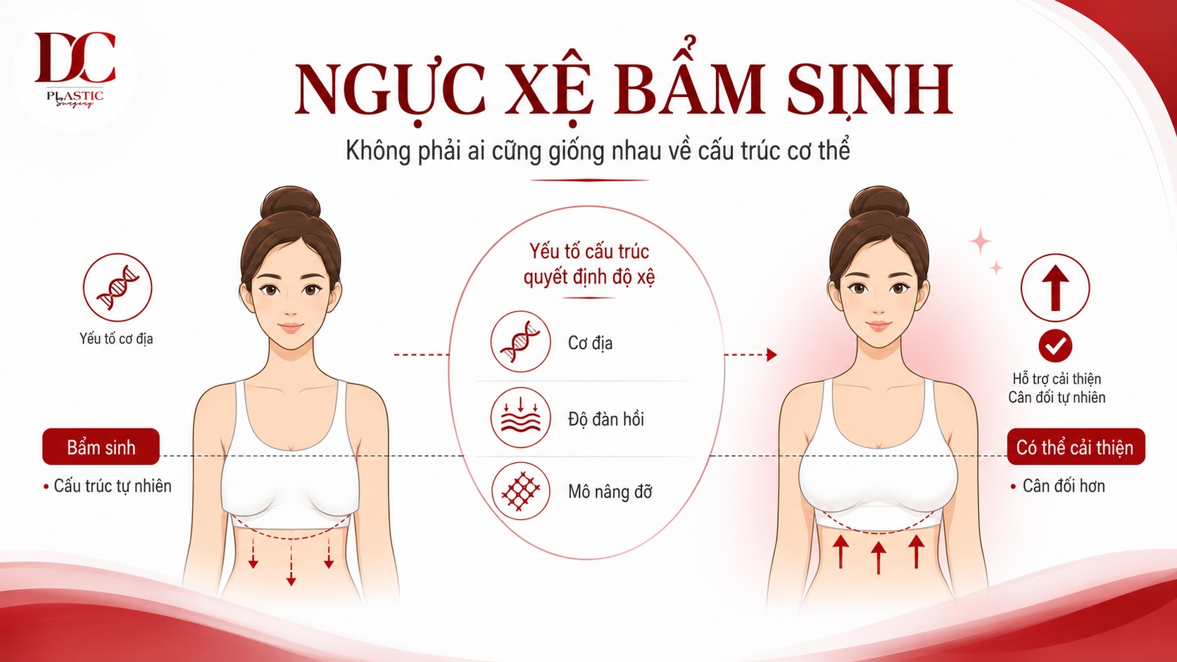 Ngực xệ bẩm sinh