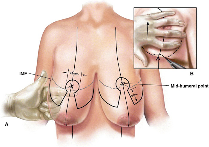 Phẫu thuật nâng ngực chảy xệ sau khi sinh