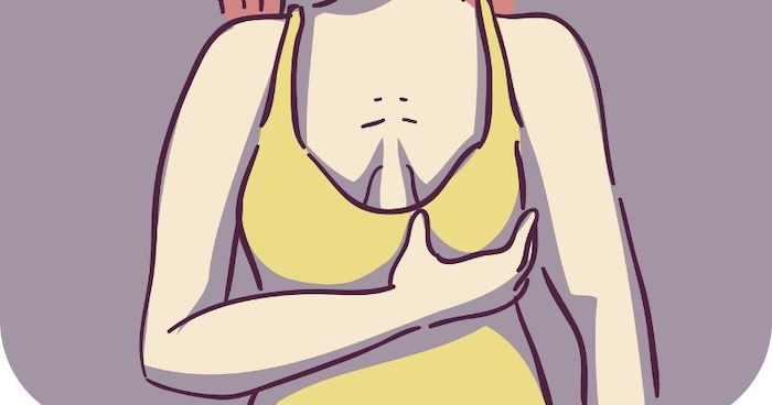 Phục hồi ngực chảy xệ sau sinh