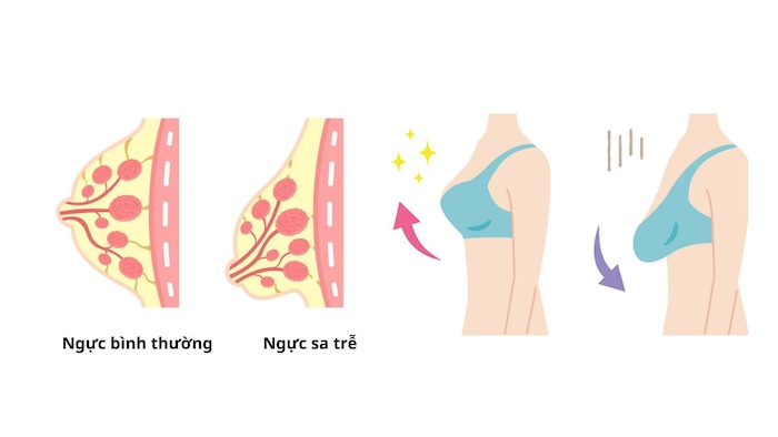 Thu gọn ngực chảy xệ