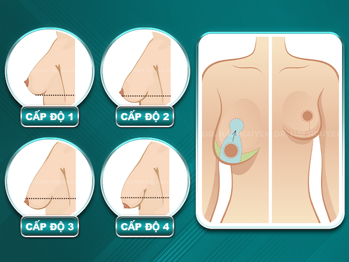 Treo ngực chảy xệ giá bao nhiêu