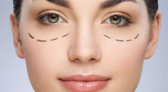 Lấy Mỡ Bọng Mắt