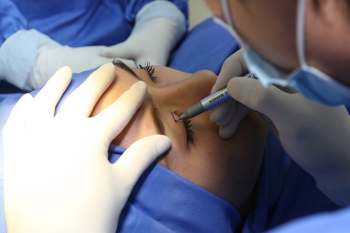 Lấy Mỡ Mí Mắt